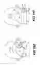 Fig. 72 - Obstructive sleep apnea treatment devices, systems and methods