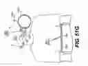 Fig. 73 - Obstructive sleep apnea treatment devices, systems and methods