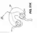 Fig. 75 - Obstructive sleep apnea treatment devices, systems and methods