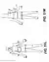 Fig. 76 - Obstructive sleep apnea treatment devices, systems and methods