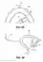 Fig. 86 - Obstructive sleep apnea treatment devices, systems and methods