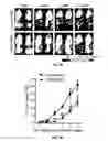 Fig. 12 - METHODS OF PROGNOSTICALLY CLASSIFYING AND TREATING GLANDULAR CANCERS