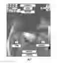 Fig. 02 - Device for cancellation of large magnetic susceptibility artifacts in magnetic resonance imaging of patients with pacemakers and implantable cardiac defibrillators