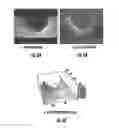 Fig. 07 - Device for cancellation of large magnetic susceptibility artifacts in magnetic resonance imaging of patients with pacemakers and implantable cardiac defibrillators