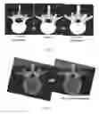 Fig. 05 - Kinematic analysis based on MRI bone marrow signals