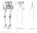 Fig. 02 - Automated aorta detection in a CTA volume