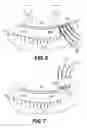 Fig. 05 - Single section lift-up technique for eyelash extensions