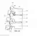 Fig. 04 - CANNULOTOME