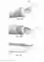 Fig. 13 - CANNULOTOME