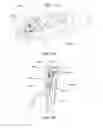 Fig. 25 - CANNULOTOME
