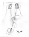 Fig. 06 - ATTACHMENT DEVICE FOR A URETEROSCOPE