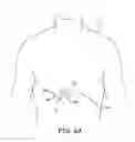 Fig. 09 - Automated calibration of posture state classification for a medical device