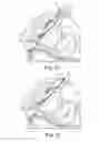 Fig. 08 - SURGICAL IMPLANT SYSTEM AND METHOD