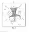 Fig. 08 - Tool useful for implanting a support in treating urinary incontinence in a patient