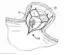 Fig. 01 - DEVICE FOR PREVENTING CLOT MIGRATON FROM LEFT ATRIAL APPENDAGE