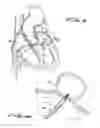 Fig. 08 - DEVICE FOR PREVENTING CLOT MIGRATON FROM LEFT ATRIAL APPENDAGE