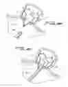 Fig. 09 - DEVICE FOR PREVENTING CLOT MIGRATON FROM LEFT ATRIAL APPENDAGE