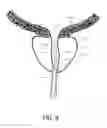 Fig. 10 - SURGICAL DEVICE AND METHOD OF USE