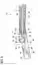 Fig. 08 - Tissue-removing catheter including screw blade and cutter driveshaft
