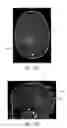 Fig. 18 - Surgical access assembly and method of using same