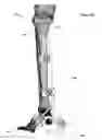 Fig. 48 - Clamping device for use with an anatomic external fixation system