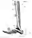 Fig. 52 - Clamping device for use with an anatomic external fixation system