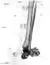 Fig. 53 - Clamping device for use with an anatomic external fixation system