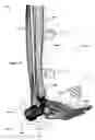 Fig. 35 - Anatomic external fixation system