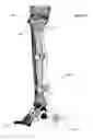 Fig. 48 - Anatomic external fixation system