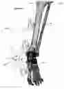 Fig. 50 - Anatomic external fixation system