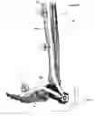 Fig. 52 - Anatomic external fixation system