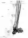Fig. 53 - Anatomic external fixation system