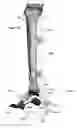 Fig. 41 - Anatomic external fixation system for the ankle