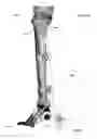 Fig. 48 - Anatomic external fixation system for the ankle