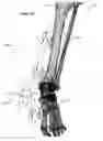 Fig. 50 - Anatomic external fixation system for the ankle