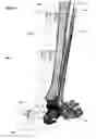 Fig. 53 - Anatomic external fixation system for the ankle