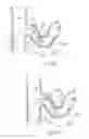 Fig. 33 - Catheter Apparatuses, Systems, and Methods for Renal Neuromodulation
