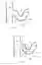 Fig. 30 - Catheter Apparatuses, Systems, and Methods for Renal Neuromodulation