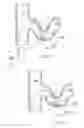 Fig. 31 - Catheter Apparatuses, Systems, and Methods for Renal Neuromodulation