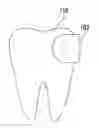 Fig. 01 - Coating for a Dental Matrix Band