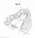 Fig. 16 - TOOTH ATTACHMENT PLACEMENT DEVICE