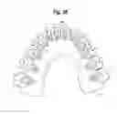 Fig. 30 - TOOTH ATTACHMENT PLACEMENT DEVICE