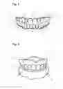 Fig. 03 - Apparatus and methods of making denture devices