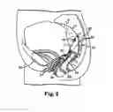 Fig. 04 - Implantable article and method