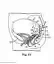 Fig. 10 - Implantable article and method