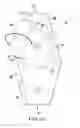 Fig. 08 - Inverse bellow prosthesis insertion device