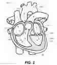 Fig. 02 - Bi-Leaflet Mitral Valve Design