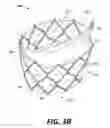 Fig. 05 - Bi-Leaflet Mitral Valve Design