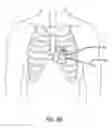 Fig. 20 - Stentless support structure