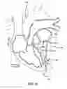 Fig. 21 - Stentless support structure